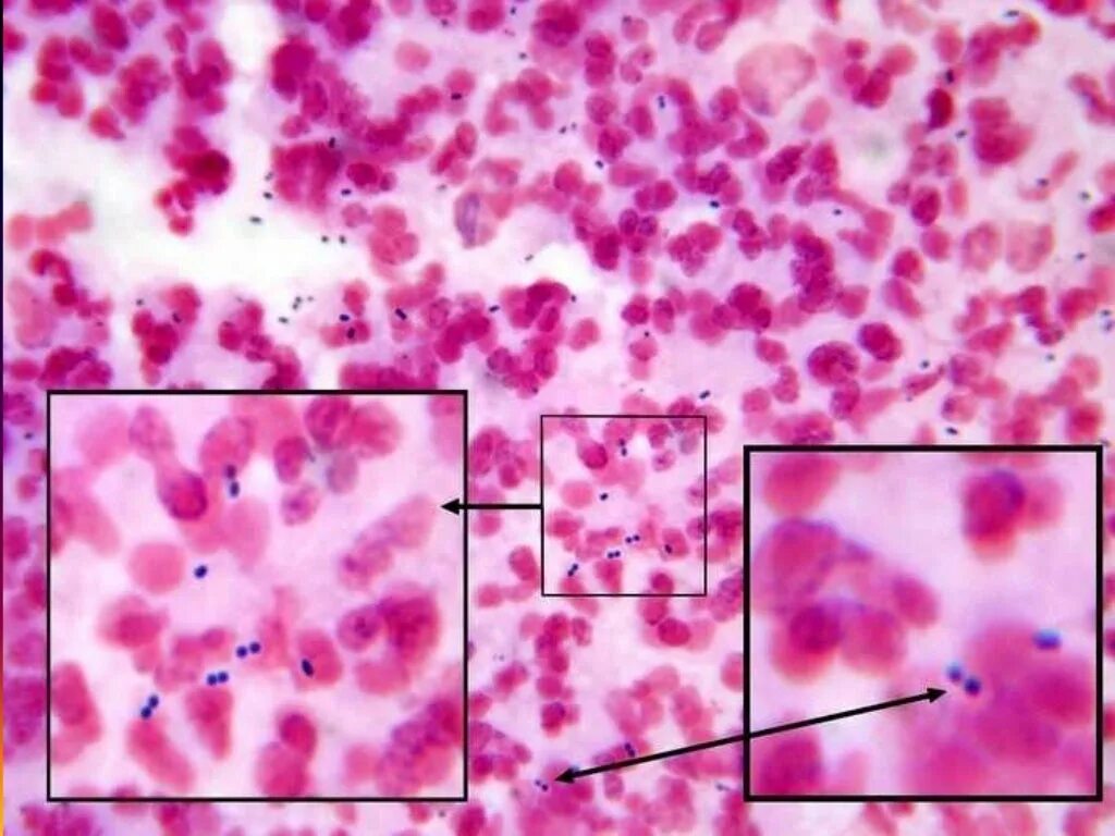 Streptococcus мазок. Пневмококк микроскопия. streptococcus pneumoniae (пневмококк). стрептококк менингитидис. стрептококк пневмония под микроскопом.