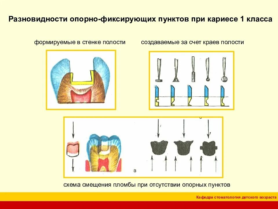 Этап формирования полости. Препарирование по 1 классу блэка этапы. препарирование кариеса 1 класса. препарирование кариозных полостей. стенки кариозной полости iv класса.