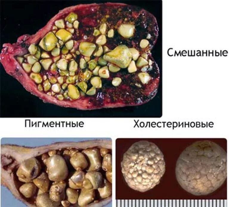 Камни желчного пузыря макропрепарат. Камни в желточном пузыре макро. ЖКБ камни желчного пузыря. Желчекаменная болезнь холелитиаз.