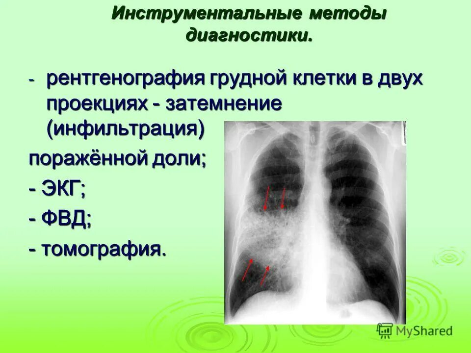 рентген грудной клетки 2 проекции. рентген грудной клетки 2 проекции. флюорография сбоку. флюорография снимок сбоку. рентген грудной клетки 2 проекции.
