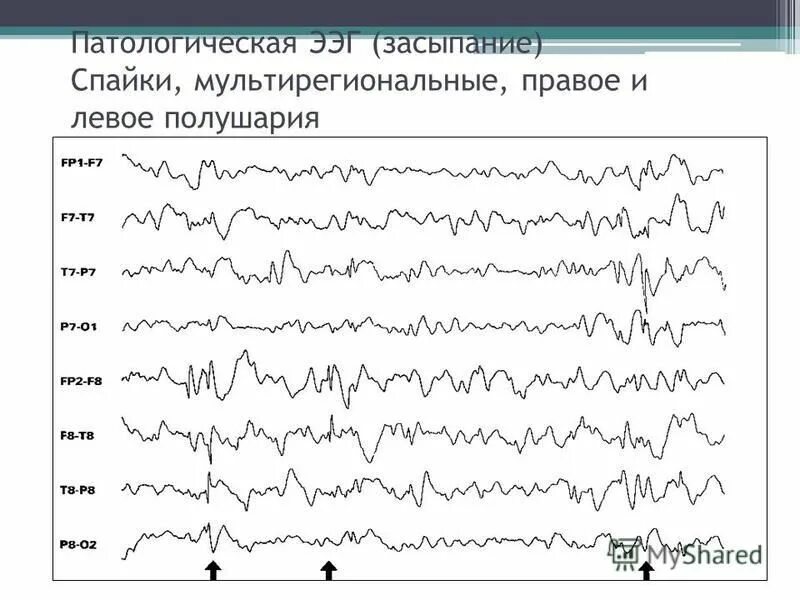 Ээг индексы. Эпилептиформная активность на ЭЭГ. Спектральные показатели ЭЭГ. Нормы ритмов при ЭЭГ.
