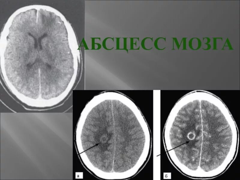 Абсцесс мозга. Абсцесса головного мозга течение. Абсцесс головного мозга мот.