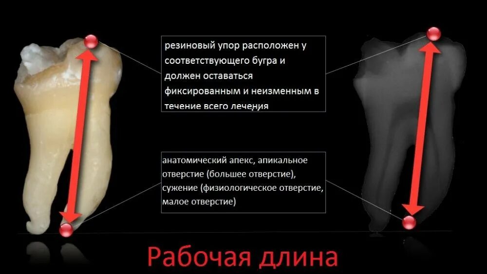 Определение рабочей длины корневого канала. Метод определения рабочей длины корневого канала. методы определения рабочей длины корневого канала зуба. способы определения рабочей длины корневого канала. рабочая длина корневых каналов зуба.