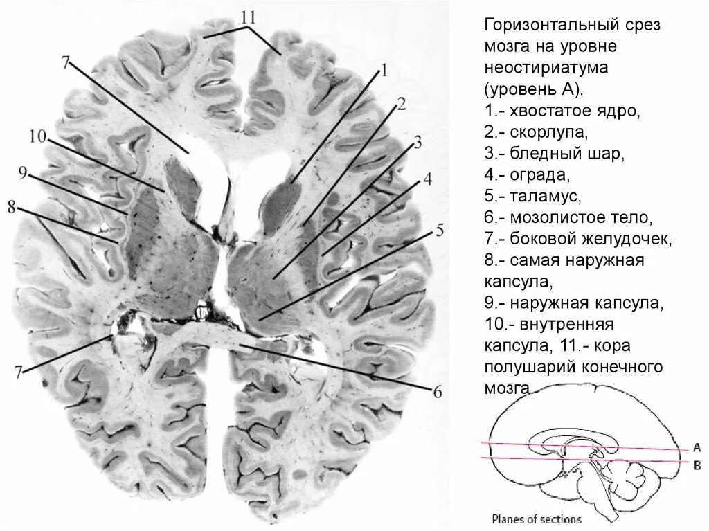Мозолистое тело фронтальный срез. Горизонтальный срез головного мозга базальные ядра. Поперечный срез головного мозга мозга. Поперечный срез головного мозга схема.