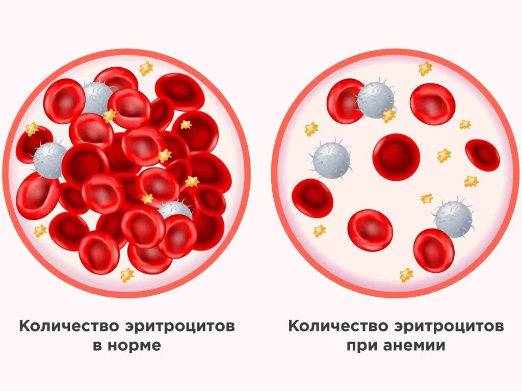 Малокровие у женщин. Железодефицитная анемия гемоглобин. Эритроциты при анемии. Анемия картинки. Эритроциты в норме и с анемией.