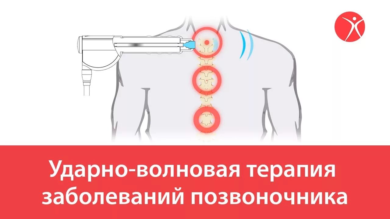 Ударно волновая терапия позвоночника. Ударно-волновая терапия плечевого сустава. Ударно-волновая спины. Ударно-волновая терапия грыжи позвоночника.