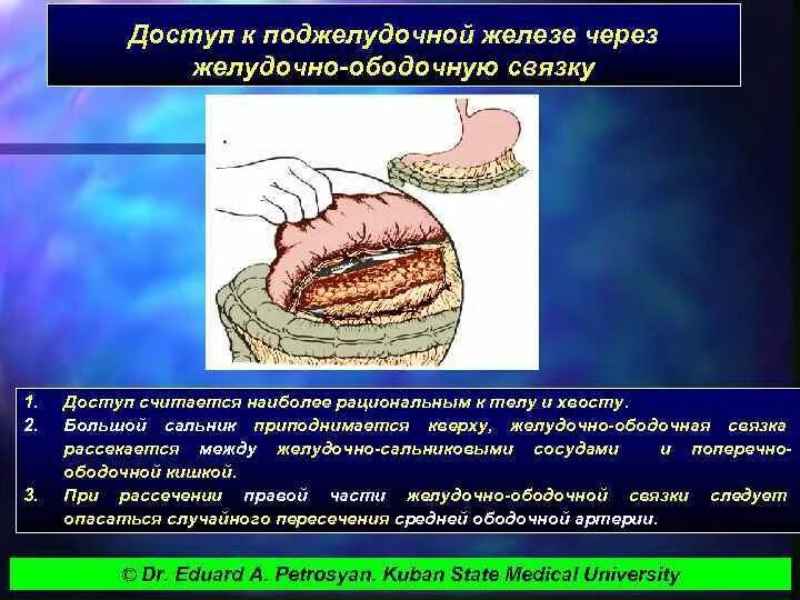 Поджелудочная железа операция отзывы. Доступ к поджелудочной железе через малый сальник. Оперативная хирургия поджелудочной железы. Доступы к поджелудочной железе. Оперативные доступы к поджелудочной железе.