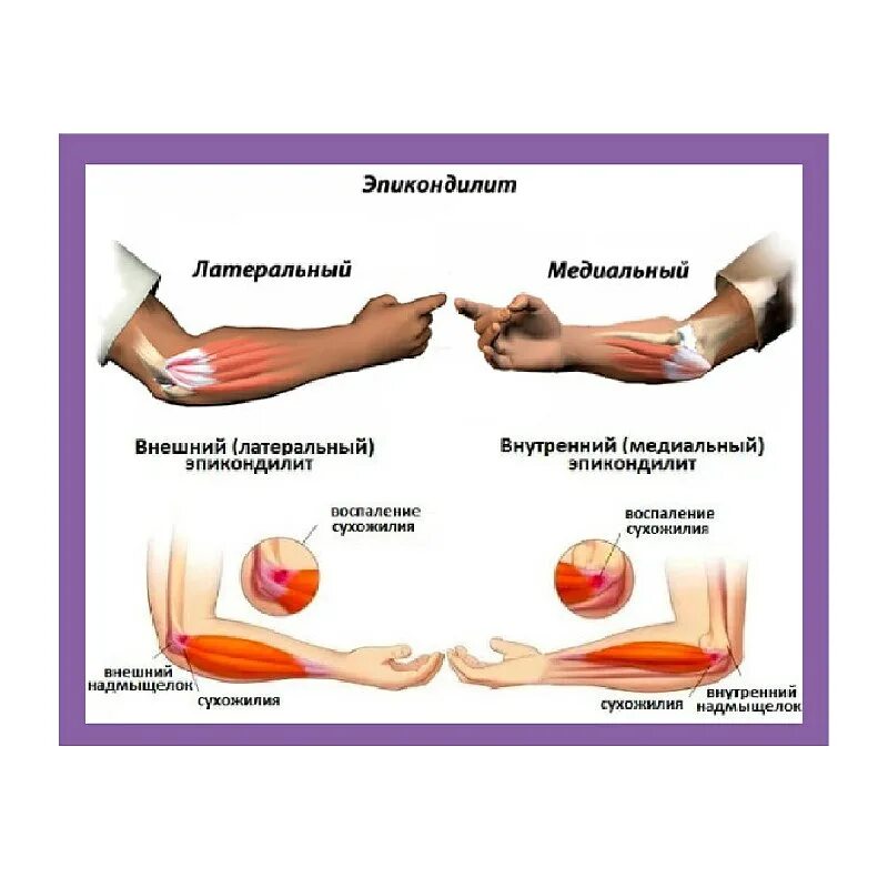 Эпикондилит локтевого сустава. Внутренний эпикондилит локтевого сустава. Внешний надмыщелок локтевого сустава. Эпикондилит локтевого сустава лечение отзывы. Латеральный эпикондилит локтевого сустава упражнения.