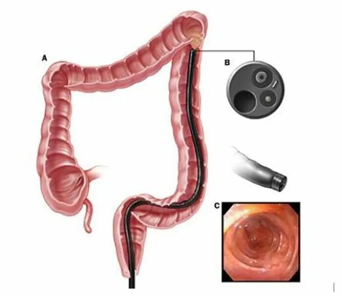 Колоноскопия сантиметр