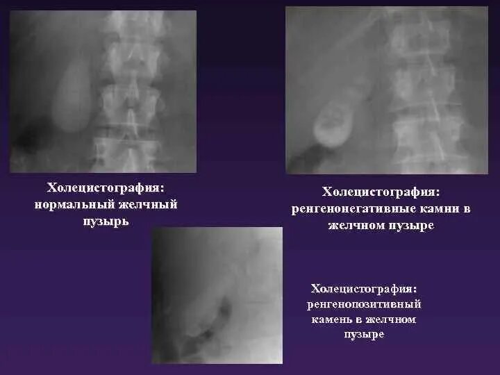 Холеграфия и холецистография. Экскреторная холецистография. Рентгенологические исследования (холецистография, холангиография):. Холецистография холеграфия холангиография. Рентген исследования желчного пузыря.