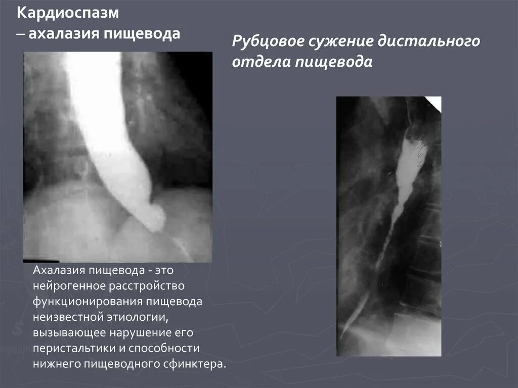 Рубцовые сужения пищевода