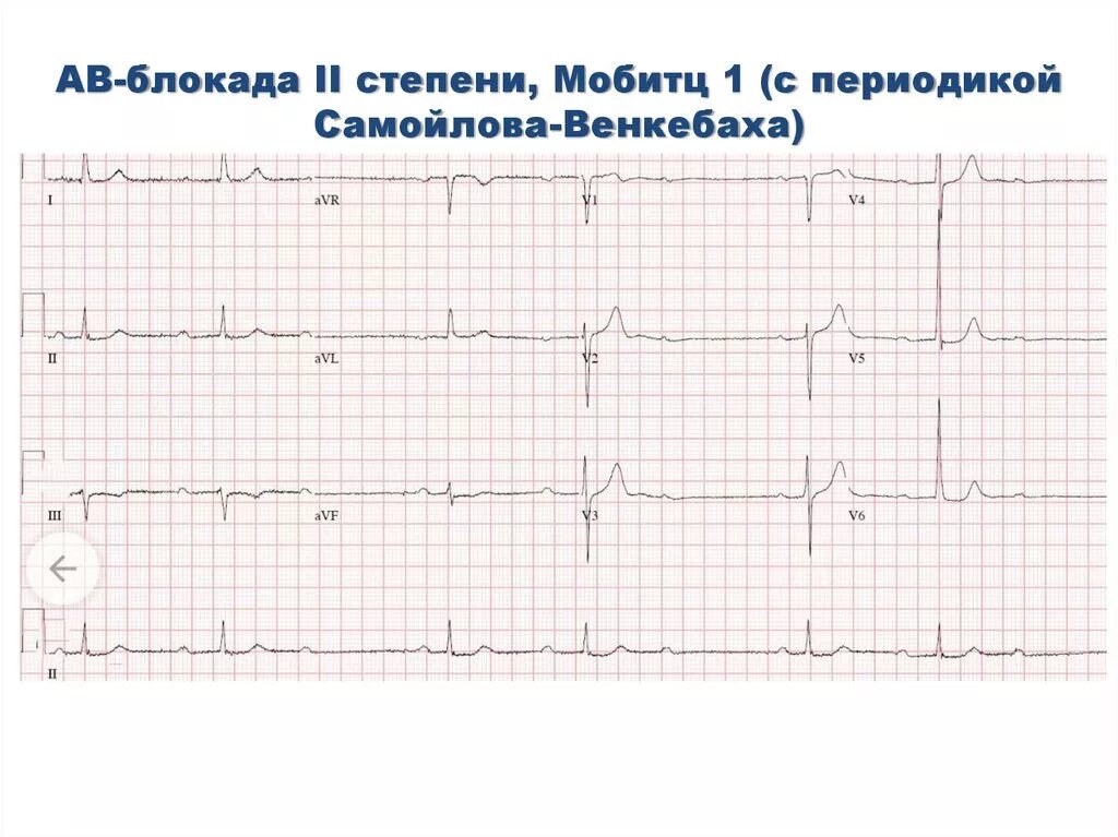 Атриовентрикулярная блокада 2. Av блокада Мобитц 1 ЭКГ. АВ блокада 2 Мобитц 1 на ЭКГ. Атриовентрикулярная блокада Мобиц 1 ЭКГ. АВ блокада 2 степени Мобитц 2 на ЭКГ.