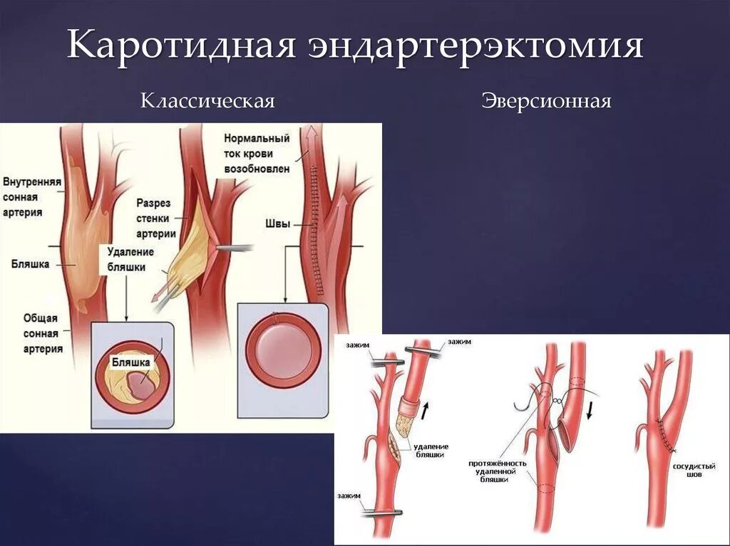 Эндартерэктомия сонной операция. Эндартерэктомия по ДЕБЕКИ. Атеросклероз сонных артерий эндартерэктомия. Эверсионная эндартерэктомия. Бляшка на шее операция