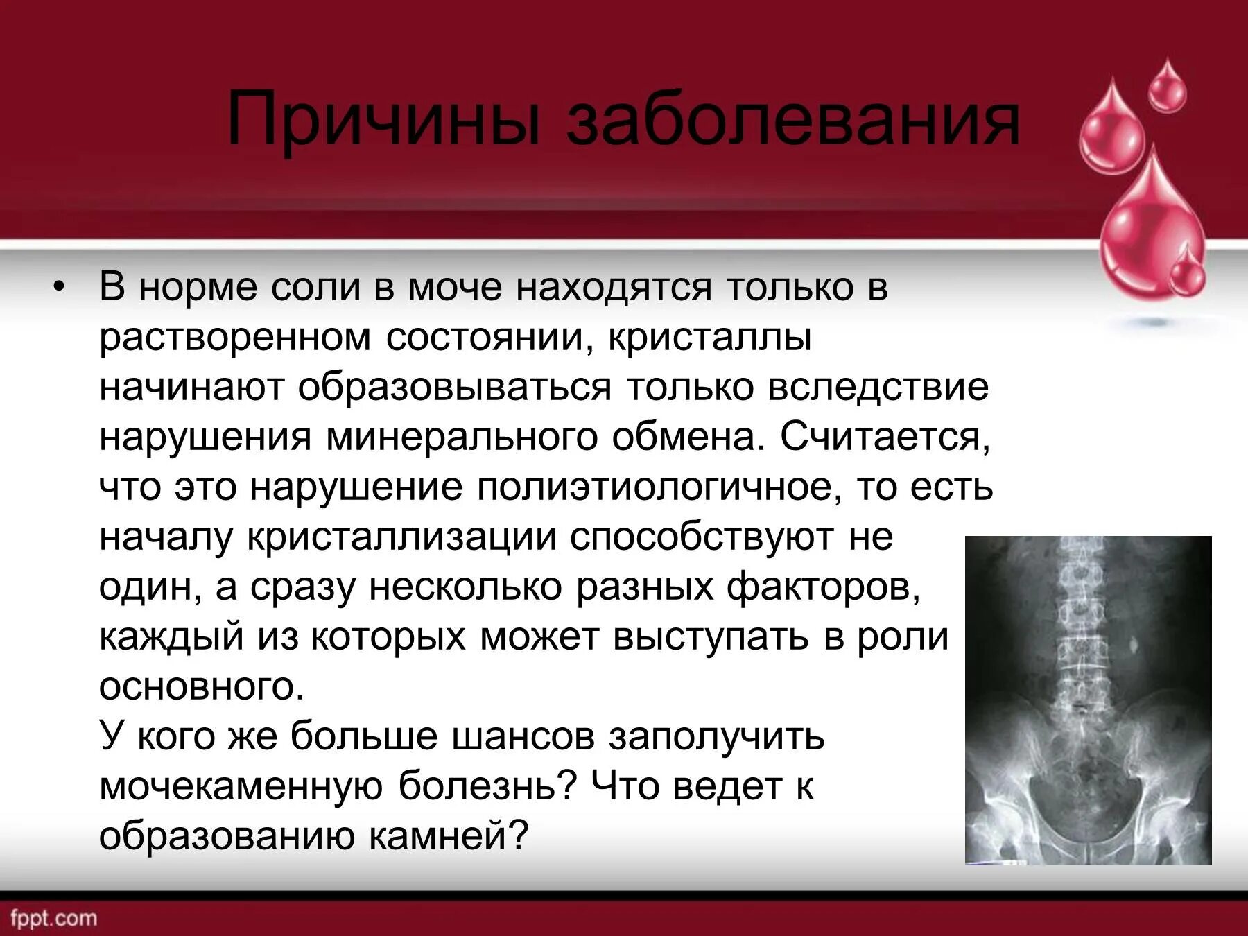 Причины мочекаменного заболевания. Мочекаменная болезнь мкб клиника. Мочекаменная болезнь презентация. Мочекаменная болезнь причины. Почечнокаменная болезнь причины.