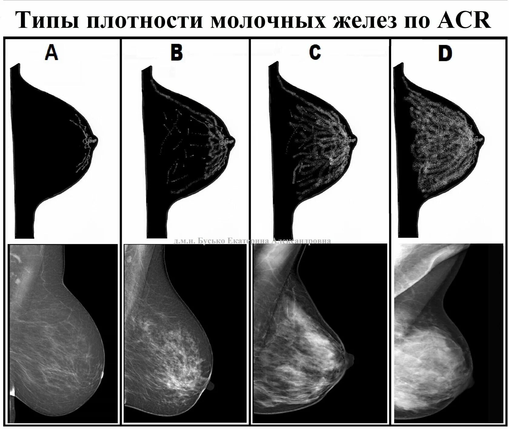 Структура желез тип в. Тип строения молочных желез по acr. железистый тип строения молочных желез. типы плотности молочных желез.
