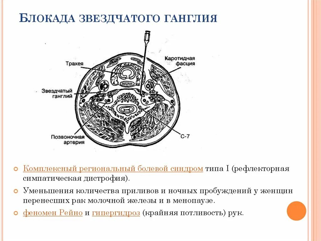 Что представляет собой ганглий. Блокада звездчатого ганглия. Блокада симпатических ганглиев. Блокада поясничных симпатических ганглиев. Блокада краниального шейного ганглия.