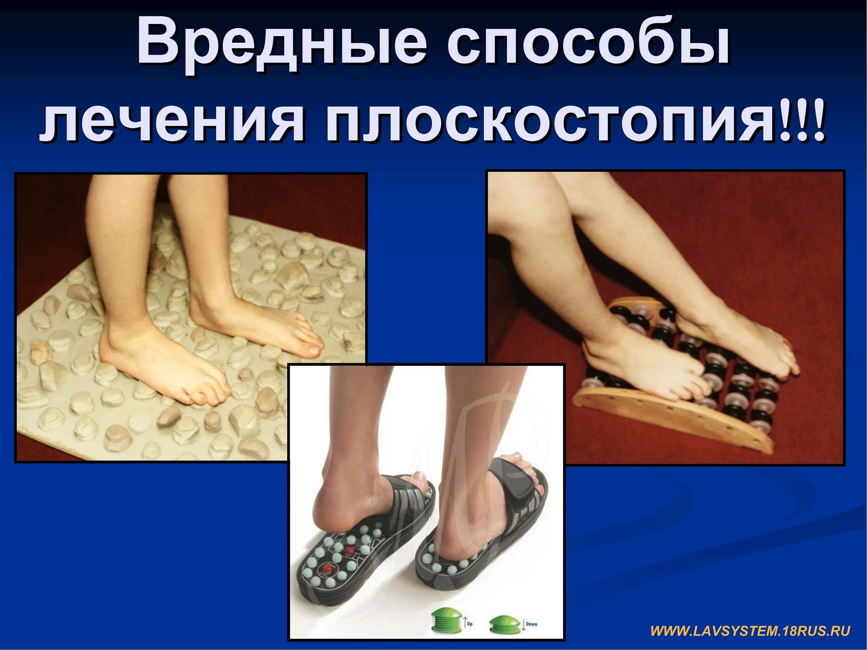 Плоскостопие врожденное или приобретенное: найдено 79 картинок
