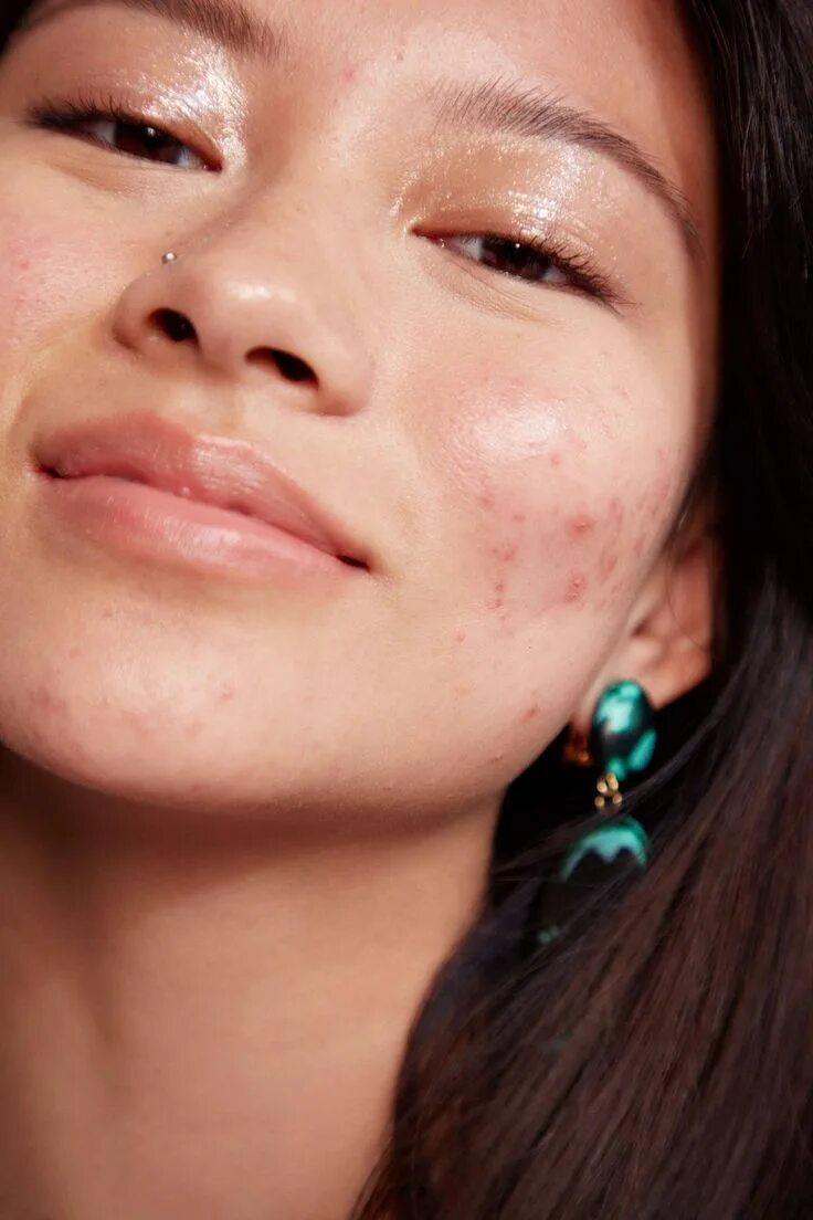 Acne pimple. Acne pimple