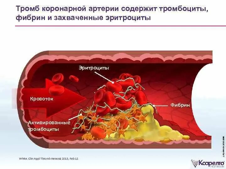 Тромбоцитарный фибрин тромбоциты. Тромбоциты образование тромба. Тромбоцитарный и фибриновый тромб. Образование тромба в коронарной артерии. Образование тромба попадание факторов