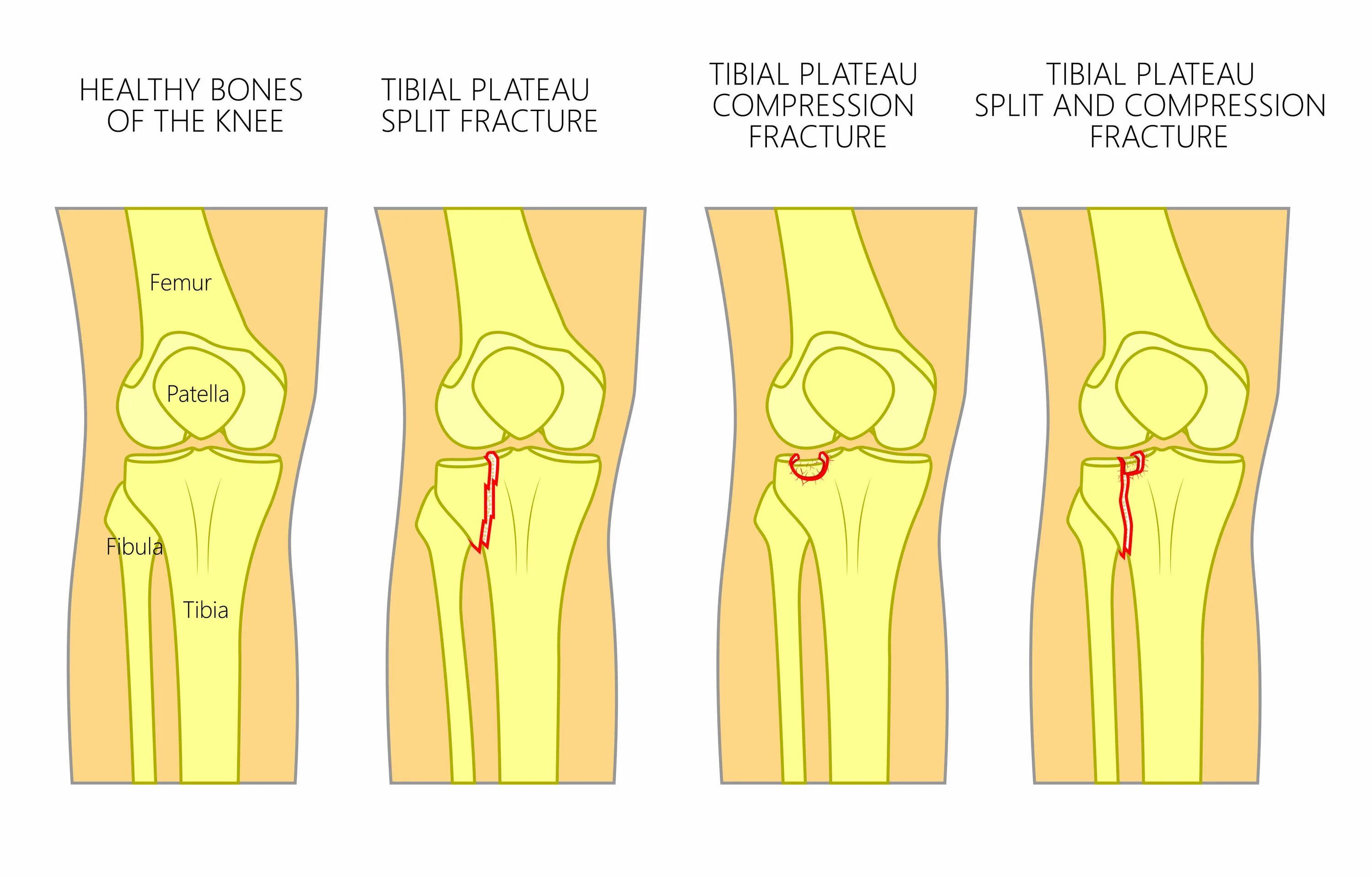 Пеоелос колен. Перелом коленч. Перелом коленного сустава. Травма коленной чашечки.