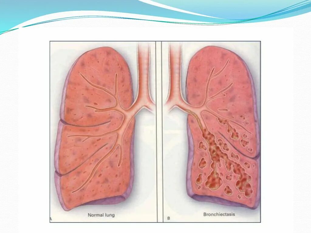 Бронхоэктатическая болезнь и эмфизема. Бронхоэктатическая болезнь легких. Бронхоэктатическая болезнь легких осложнения. Бронхоэктатическая болезнь легких на кт. Вода в легких название
