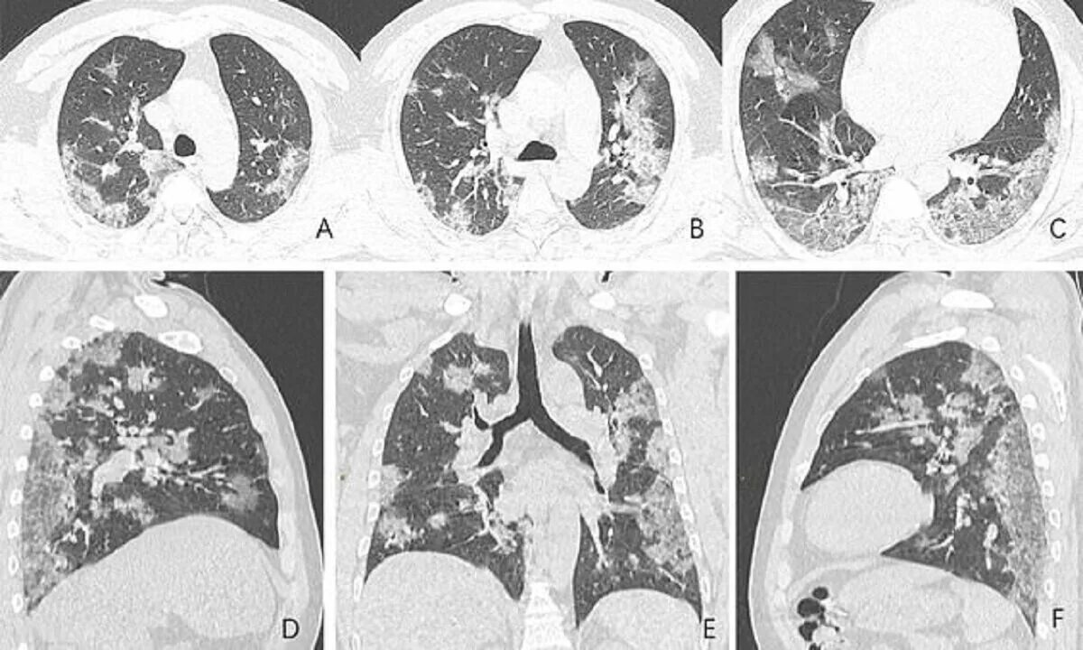 Лечение легких после коронавируса. Кт легких пневмония коронавирус. Вирусная пневмония ковид кт. Кт снимки легких при коронавирусе.