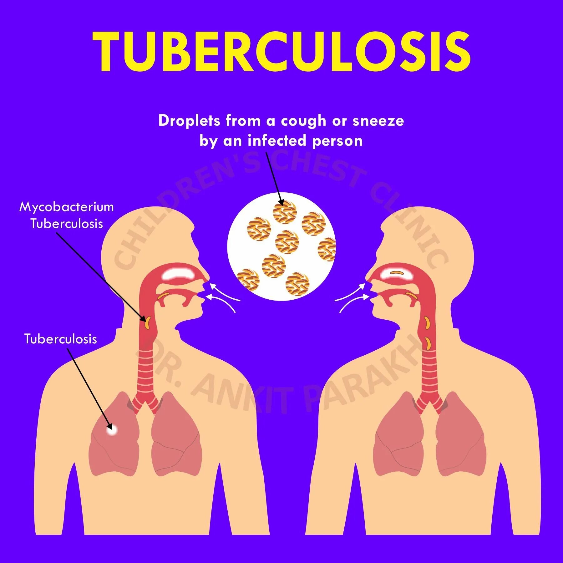 Tuberculosis disease. Prevention of tuberculosis. Tuberculosis disease. Girl sick with tuberculosis on the illustration. Симптомы туберкулеза на английском языке.