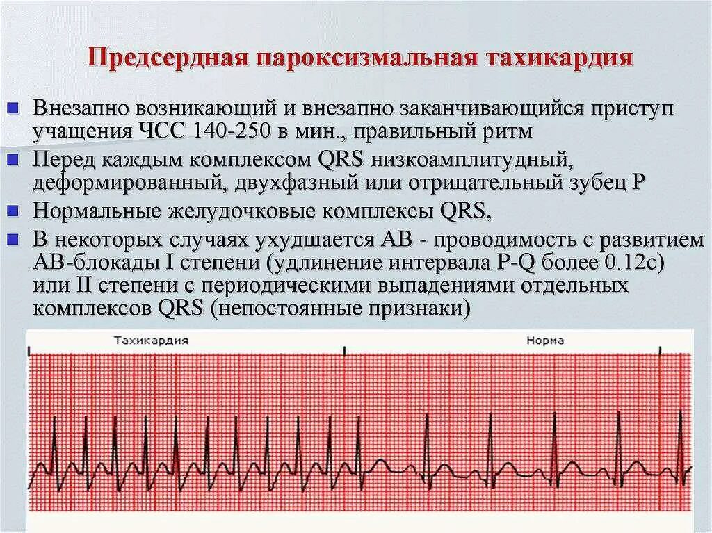 Нормализовать ритм. Отрицательный зубец р после QRS комплекса. Предсердная пароксизмальная тахикардия на ЭКГ. Предсердная пароксизмальная тахикардия на ЭКГ признаки. ЭКГ критерии пароксизмальной суправентрикулярной тахикардии.