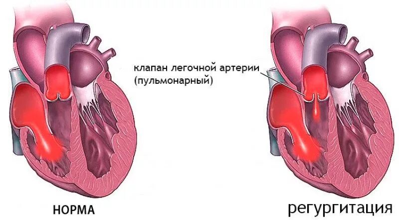 Регургитация легочного клапана 1 степени