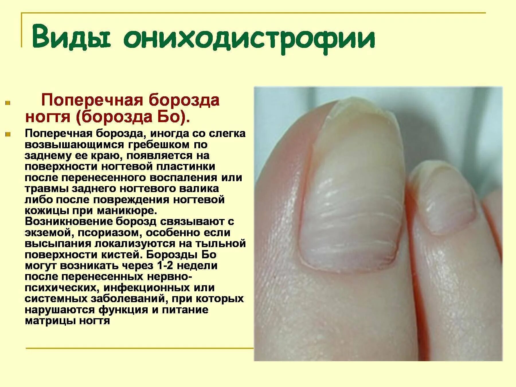 Почему ногти становятся жесткими. Попеперечные борозды на ногте. Поперечные борозды на ногтях. Продольные и поперечные борозды на ногтях.