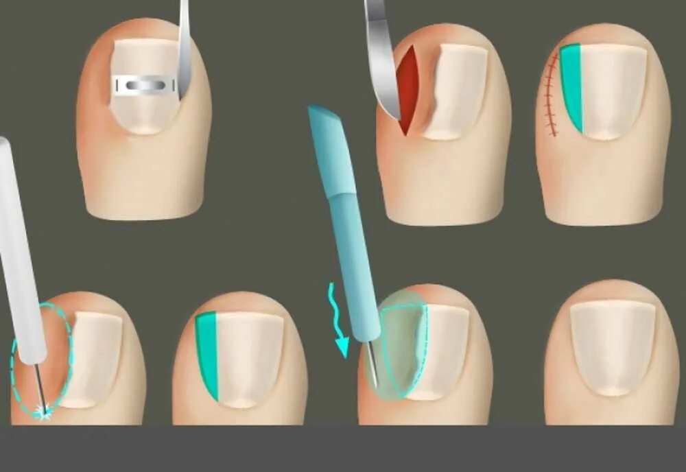 Операция вросшогоногтя. Хирургический вырезание вросшего ногтя. Врезаются ногти что делать