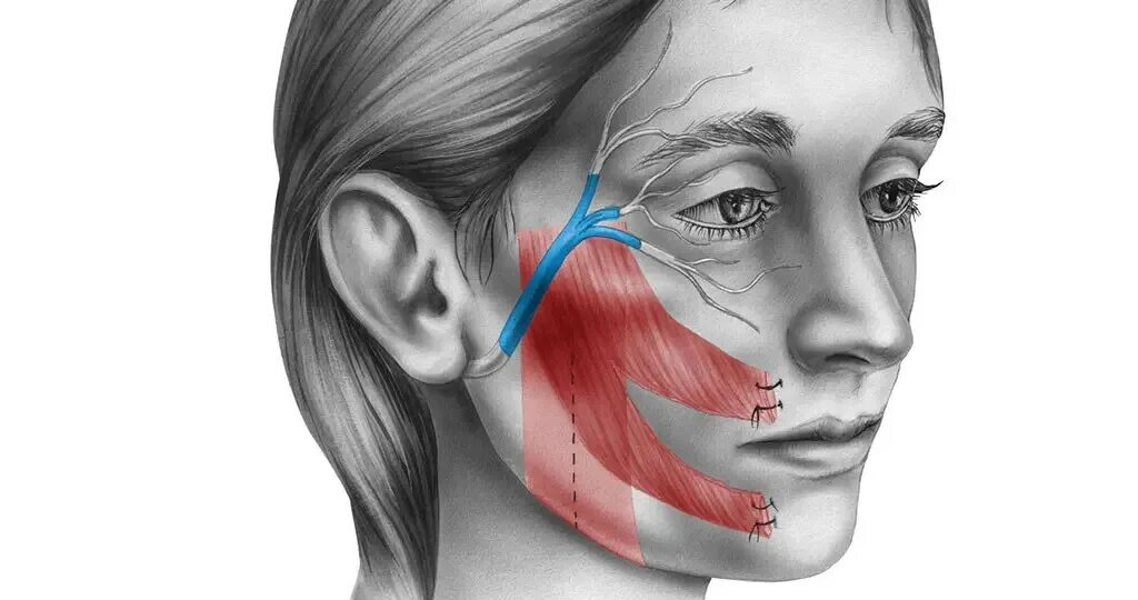 Повреждение нервов лица