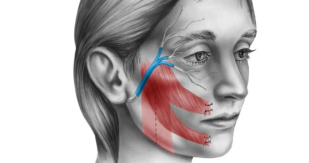 Паралич тройничного нерва. Неврит тройничного нерва симптомы. Невропатия (неврит) лицевого нерва..