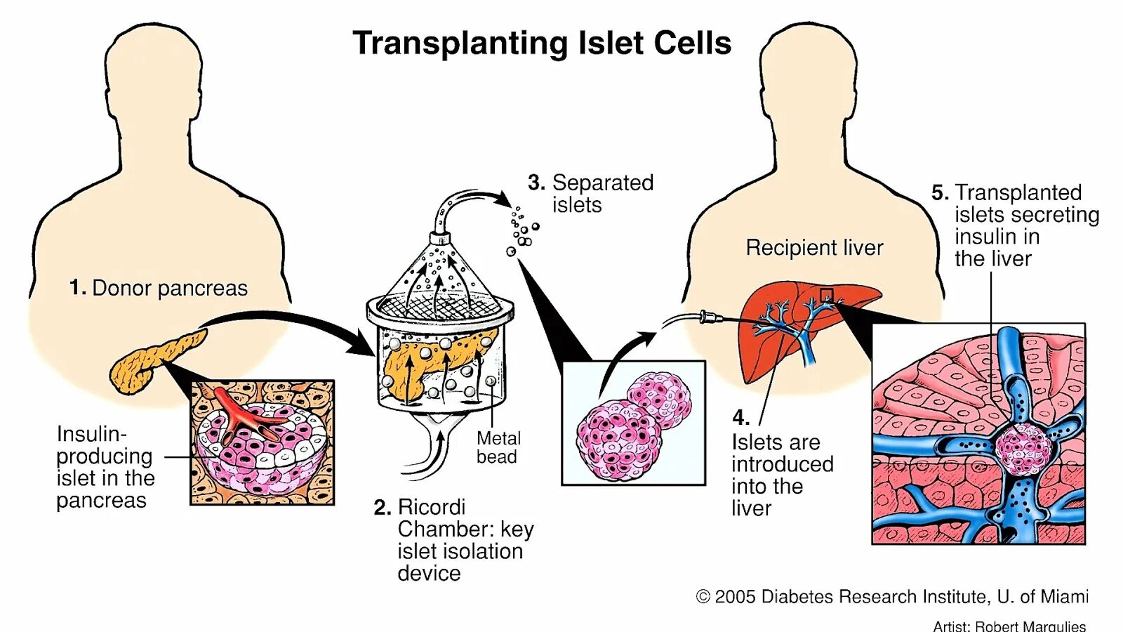 Пересадка островков Лангерганса. Сахарный диабет поджелудочная железа с бета клетками. Пересадка панкреатических островковых клеток. Трансплантация клеток поджелудочной железы. Пересадка поджелудочной при диабете