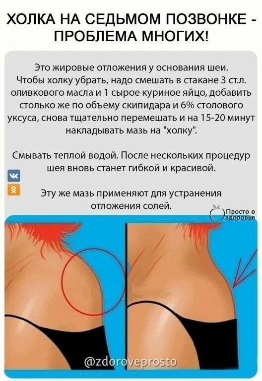 Эффективные упражнения убрать холку. Вдовий горб после массажа. Можно убрать холку на шее массажем. Можно убрать холку на шее массажем. Можно убрать холку на шее массажем.