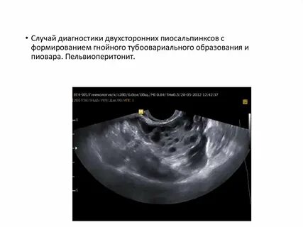 Тубоовариальное образование