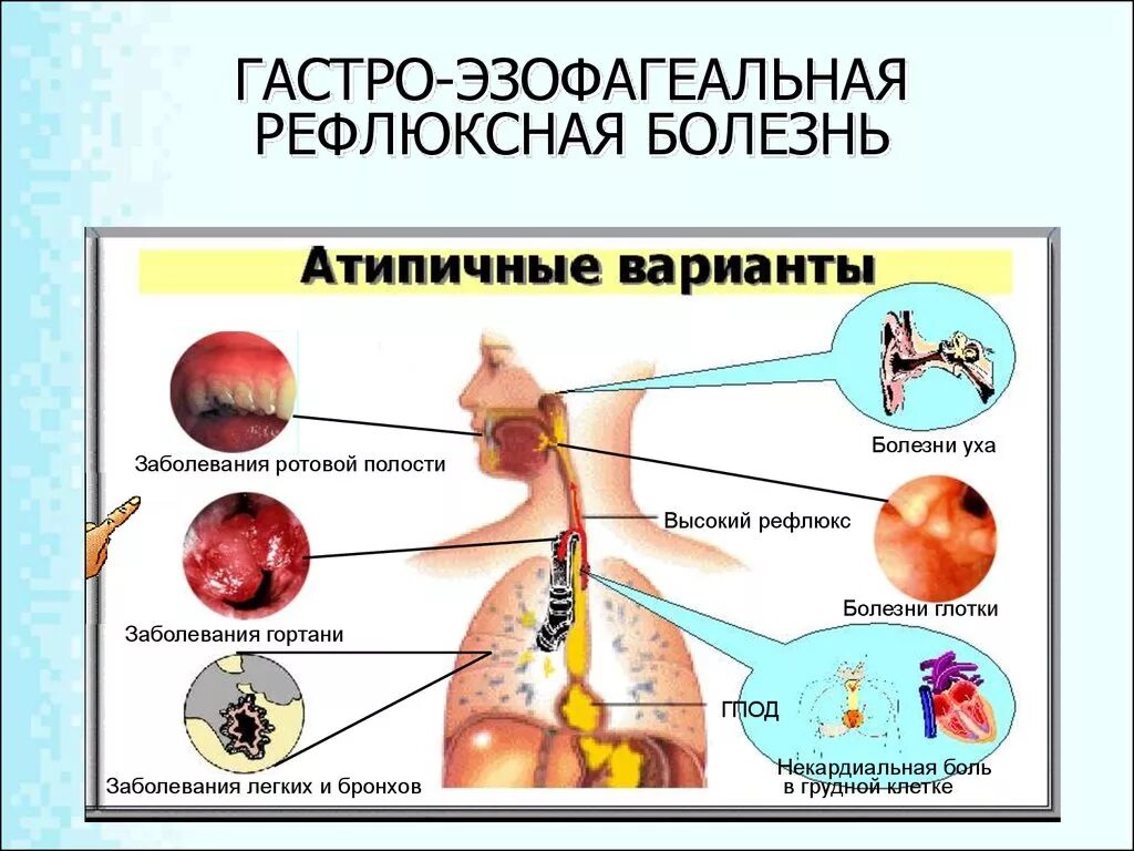 Лечение гастроэзофагеального рефлюкса у взрослых. Гастро-рефлюксная болезнь симптомы. Симптомы гастроэзофагеальной рефлюксной болезни симптомы. Гастроэзофагеальная рефлюксная болезнь симптомы. Гастроэзофагеальным рефлюксом симптомы.