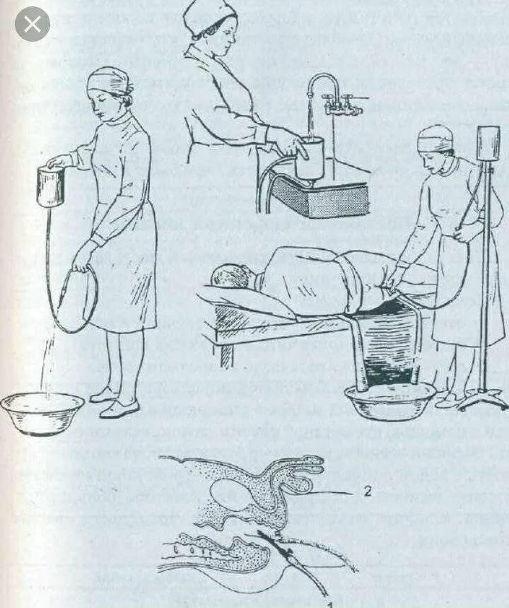 Выполнение очистительной клизмы. Сифонная клизма алгоритм. Очистительная и сифонная клизма. Очистительная клизма алгоритм. Постановка сифонной клизмы алгоритм.