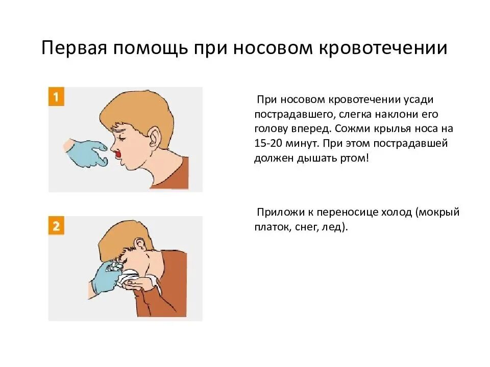 При носовом кровотечении применяют. ПМП при носовом кровотечении. ПМП при кровотечении из носа. Как оказать первую медицинскую помощь при кровотечении из носа. При носовом кровотечении больной должен лежать.