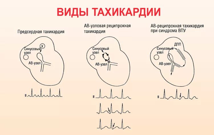 Тахикардия. Виды тахикардии. Тахикардия сердца. Учащенное сердцебиение.