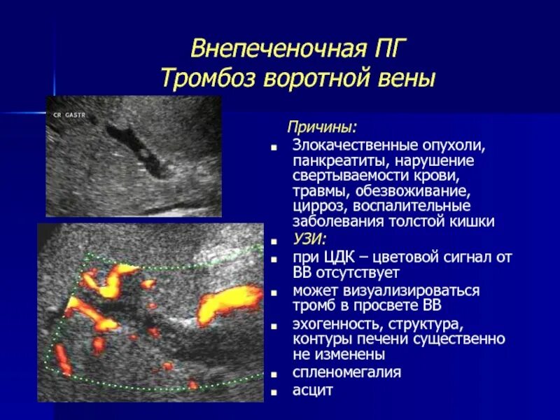 Опухолевый тромб в воротной Вене. Неокклюзивный тромбоз воротной вены. Тромбоз печеночных вен на кт. Тромбоз селезеночной вены на УЗИ. Тромб в печени