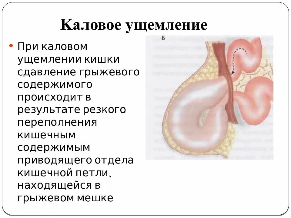 Признаки ущемленной грыжи