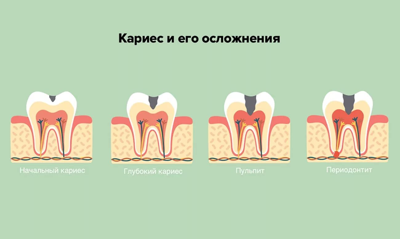 Осложнения лечения кариеса. Периодонтит осложненный кариес. Кариес пульпит периодонтит. Классификация кариес пульпит периодонтит. Осложнения кариеса, воспаление пульпы.