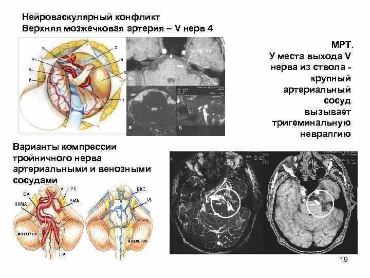 Мрт черепных нервов. Аневризма верхней мозжечковой артерии мрт. Нейроваскулярный конфликт тройничного нерва. Невралгия тройничного нерва (5 пара черепно-мозговых нервов). Нейроваскулярный конфликт мрт анатомия.