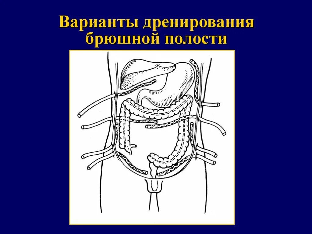 Аспирационное дренирование брюшной полости. Перитонит дренирование брюшной полости. Перитонит дренаж после операции. Перитонит активное дренирование. Абдоминальная операция что это