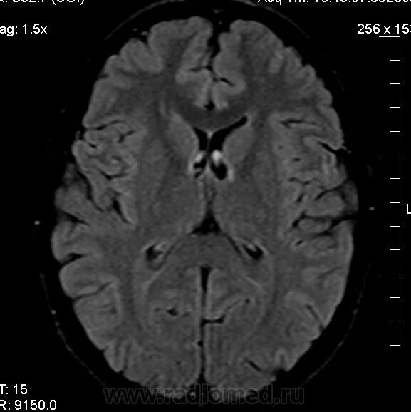 Глиоз полушарий мозга. Глиоз на мрт. Перивентрикулярный глиоз кт голова. Перивентрикулярные очаги глиоза. Паравентрикулярно и перивентрикулярно.