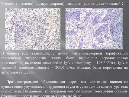 Анализ антитела к тканевой трансглутаминазе