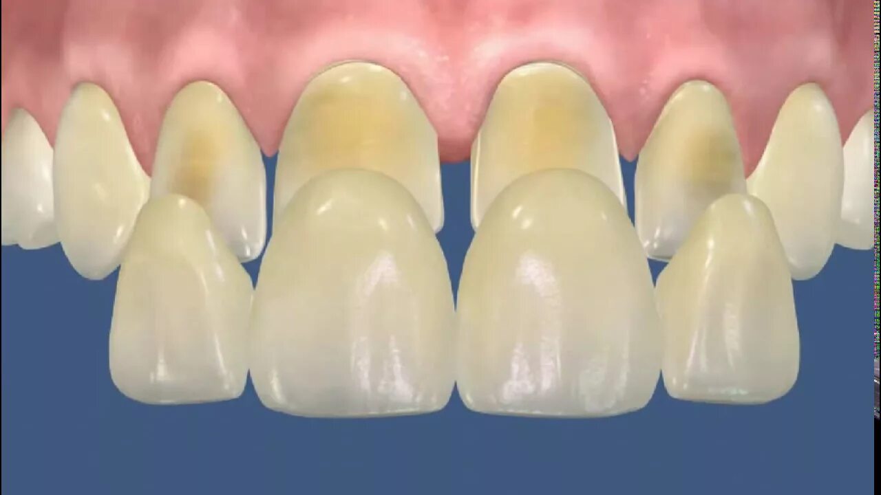 Типы реставраций. Методы препарирования зубов под виниры. Препарирование зуба под АИНИРЫ. Об очка зубов под винирыт.