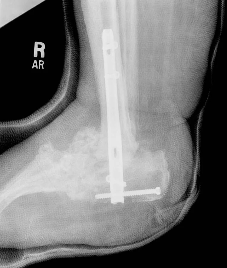 Артродез суставов операция. Подтаранный артродез рентген. Подтаранный артродез операция. Артродез голеностопного сустава рентген.