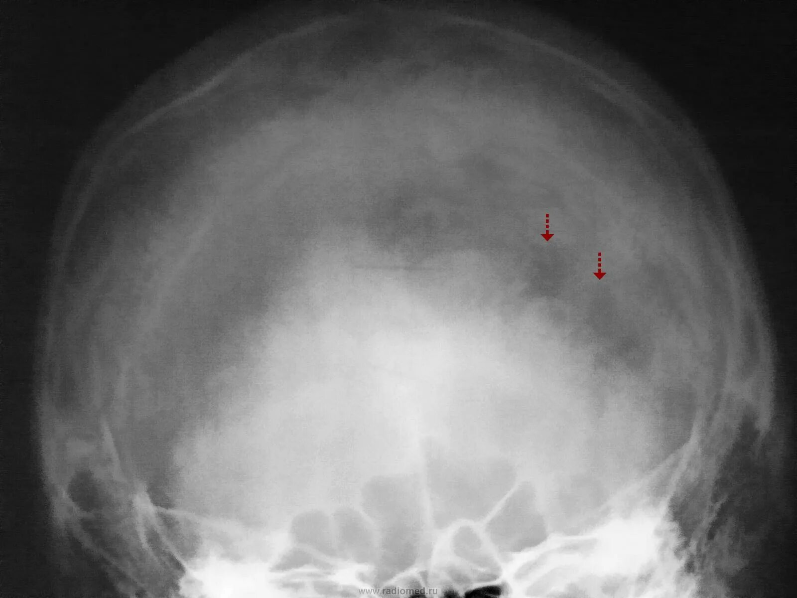 Киста в лобной доле. Пахионовы грануляции рентген черепа. Пахионовы грануляции на кт черепа. Пахионовы грануляции в затылочной кости на кт.